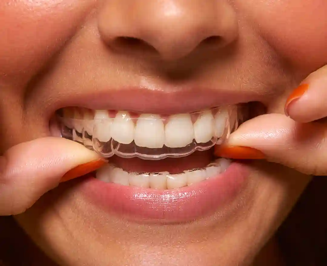 Alinhadores Invisíveis da Sou Smile