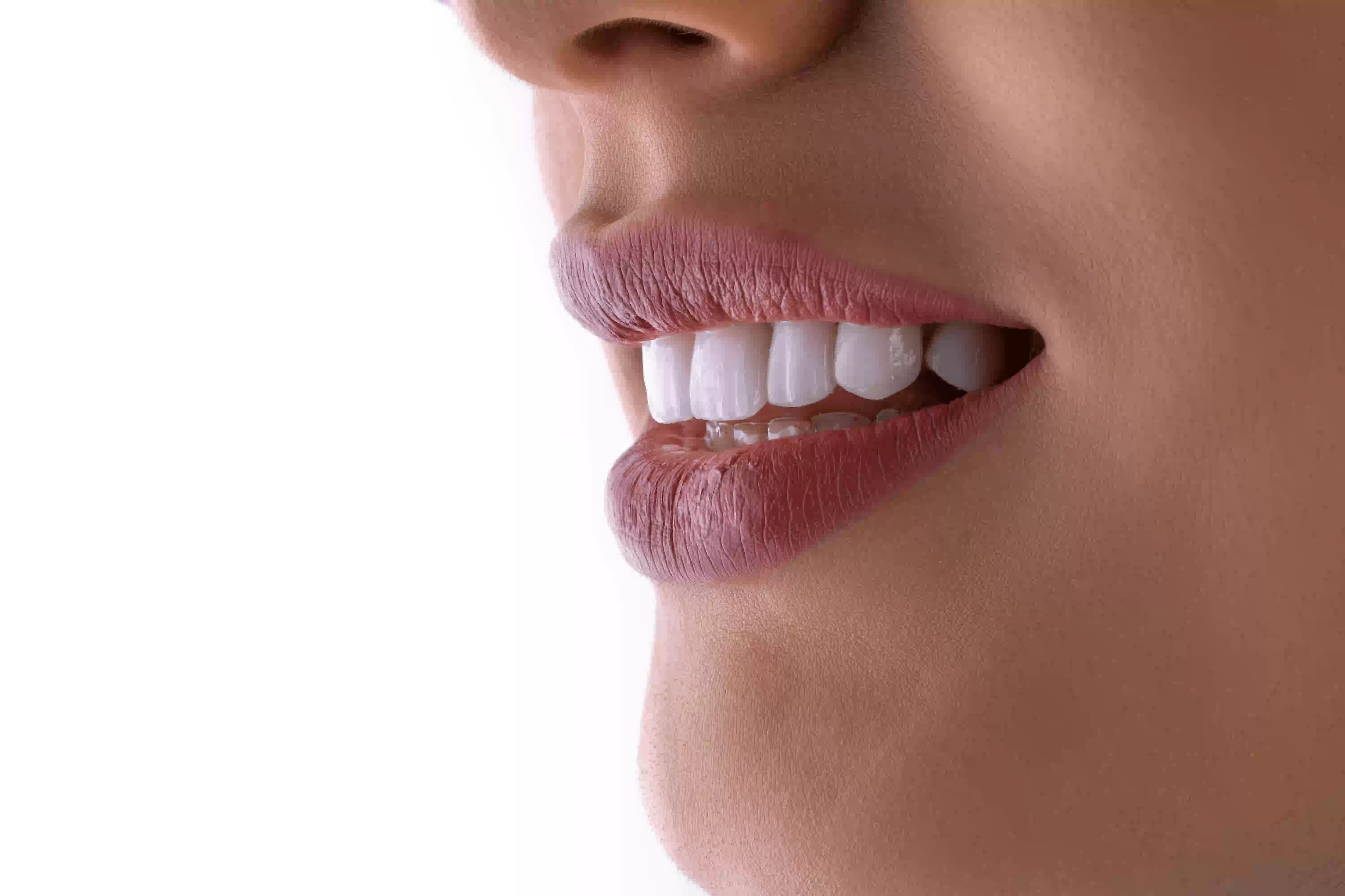 Clareamento Dental