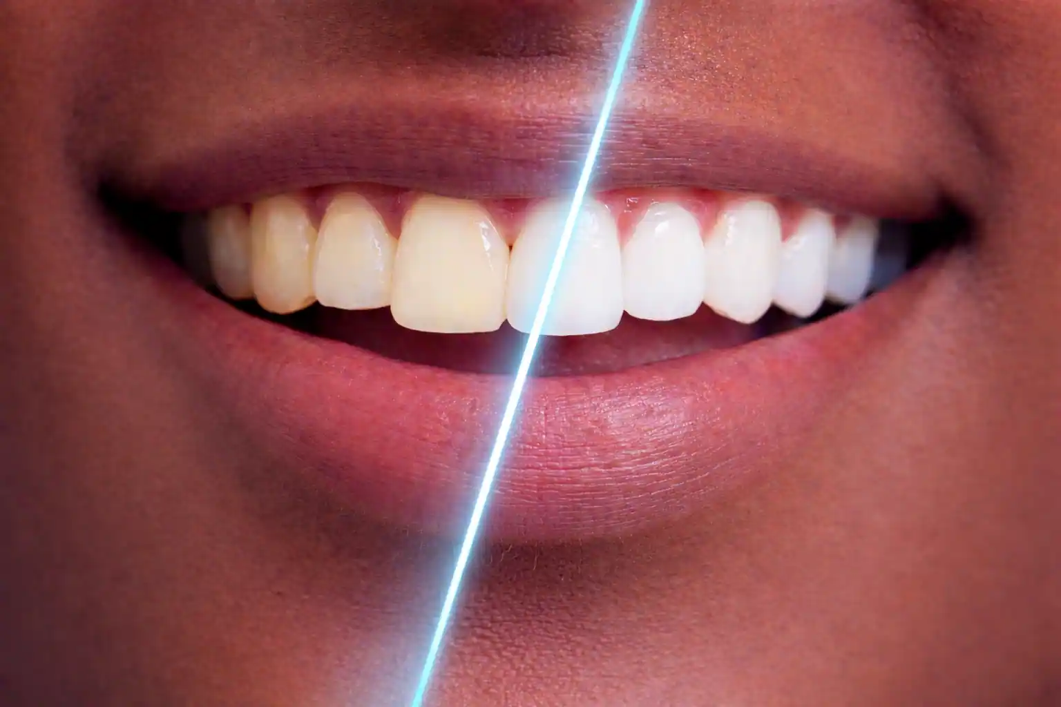 Clareamento Dental